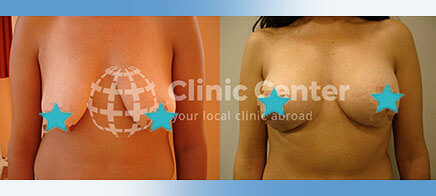 Breast Uplift with Implant