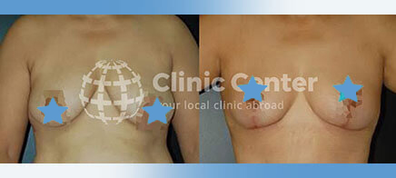 Breast Reduction 13