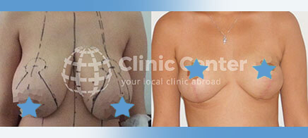 Breast Reduction 14