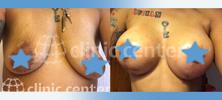 Breast Implant Uplift 08