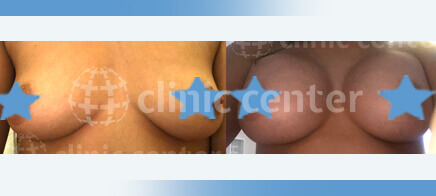 Breast Implant Uplift 07