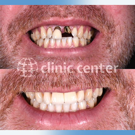 Dental Veneers Crowns Implants Whitening