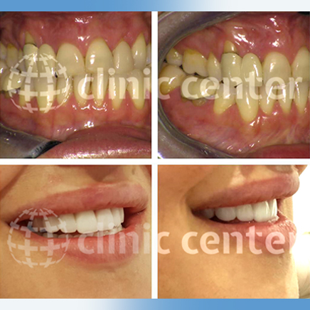 Dental Veneers Crowns Implants Whitening