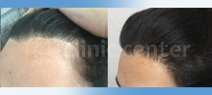 Hair Transplant Cost UK - Get Prices & Free Consultation Surgery
