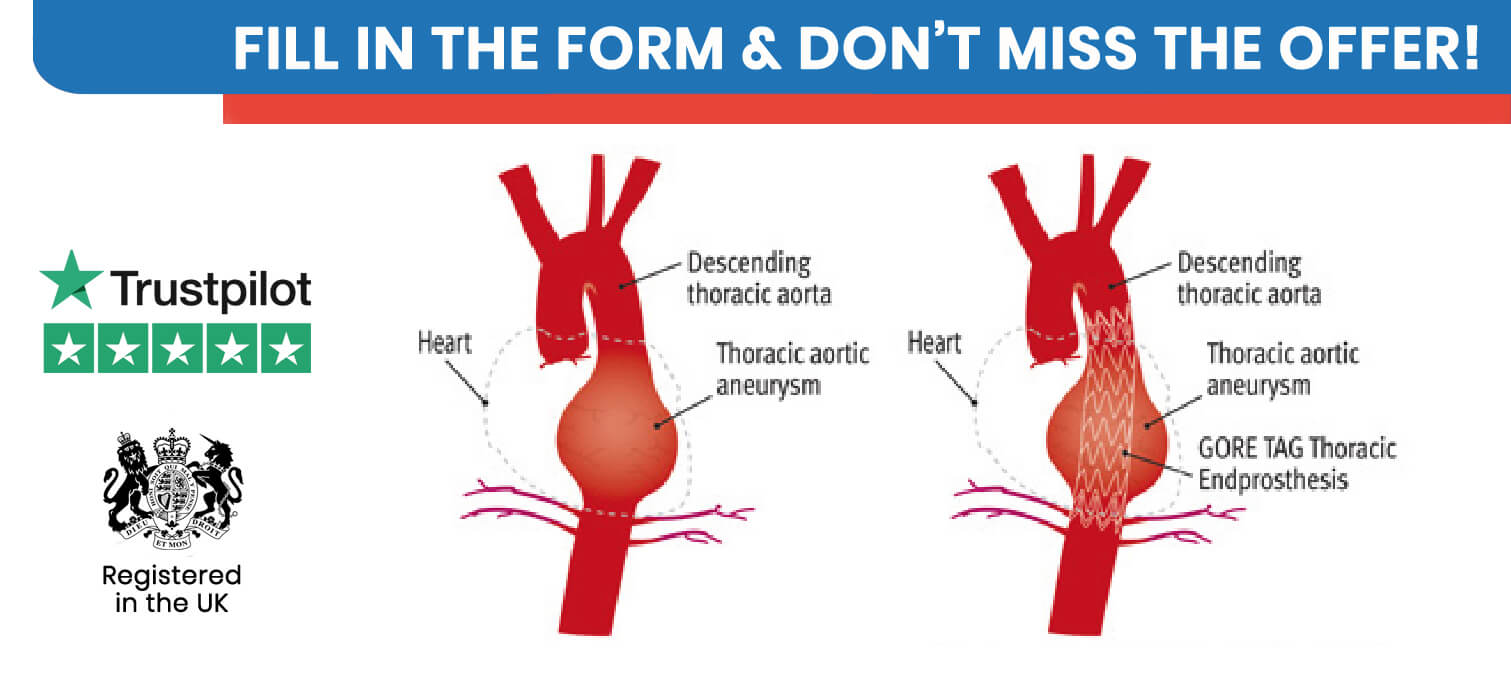 Aortic Aneurysm Surgery in Turkey