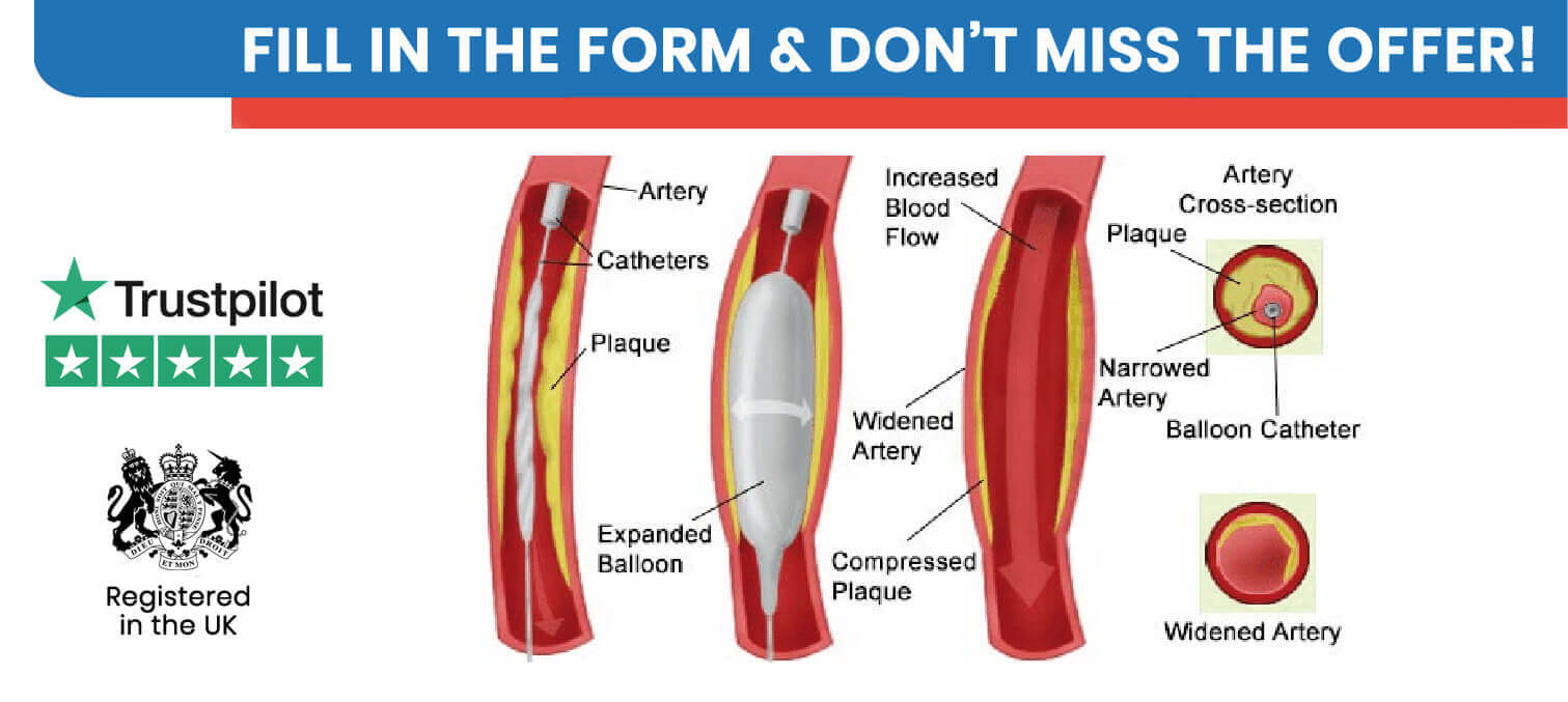 Baloon Angioplasty in Turkey