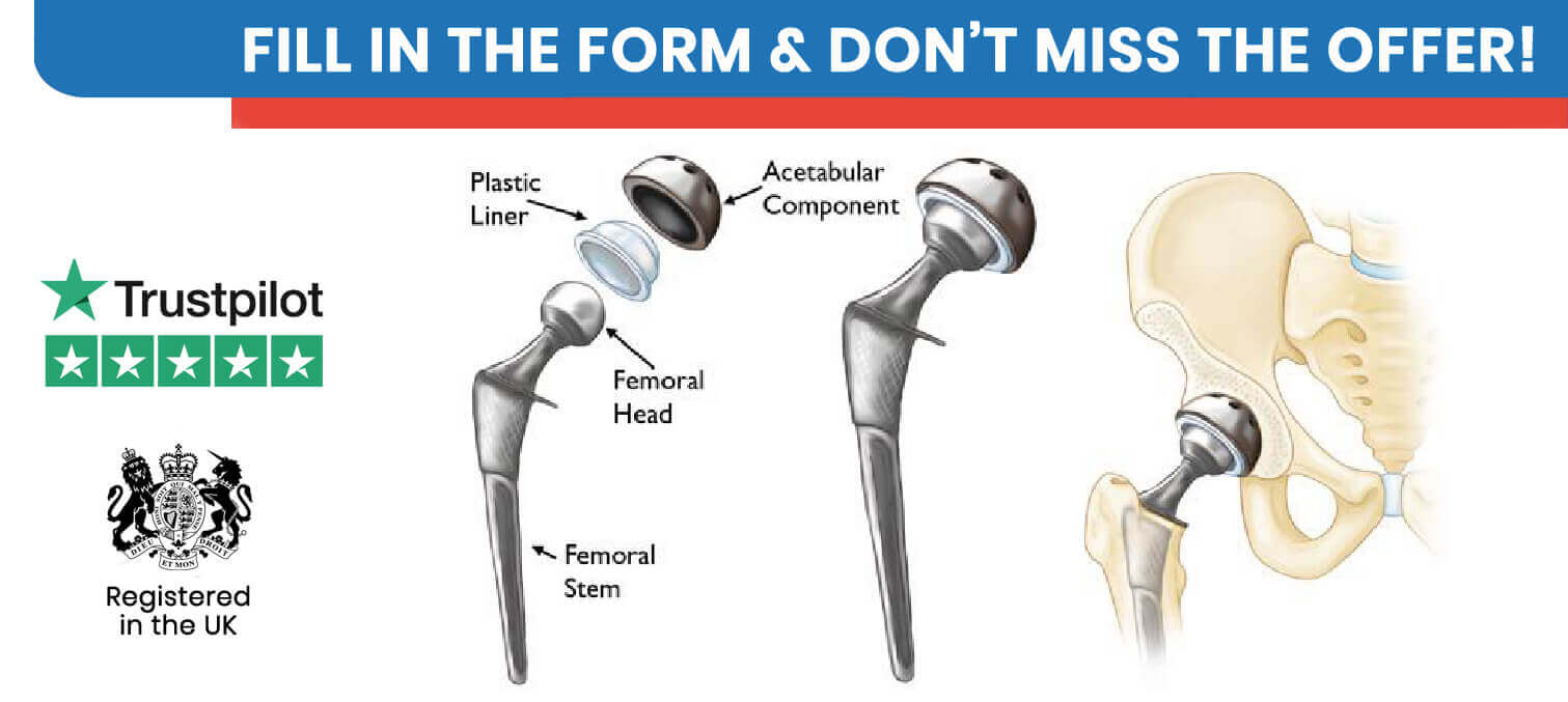 Hip Replacement in Turkey