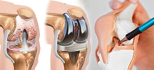 Knee Replacement