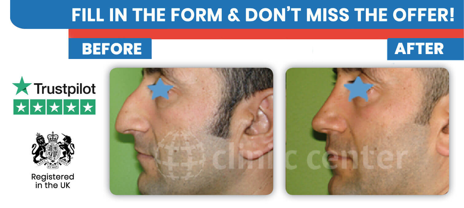 Septorhinoplasty in Turkey