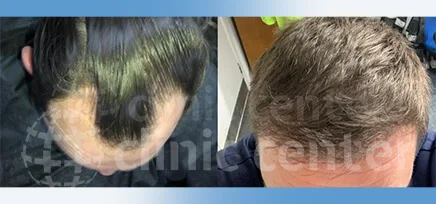 Hair Transplant 58