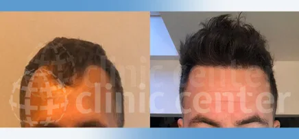 Hair Transplant 66