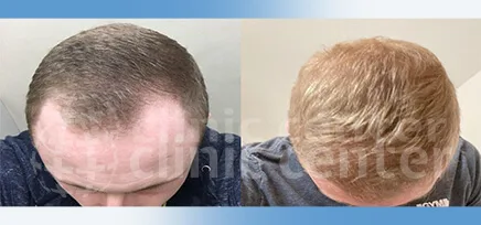 Hair Transplant 75