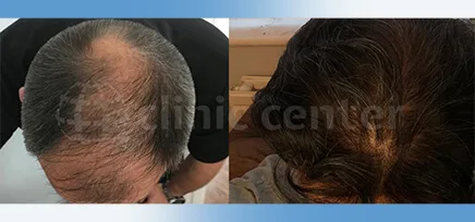 Hair Transplant 80