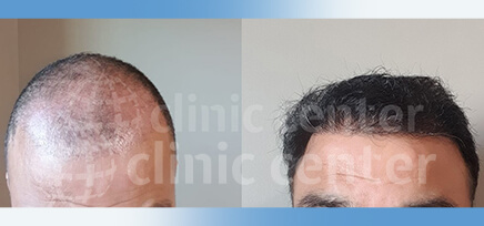 Hair Transplant Before and After | Gallery | Clinic Center