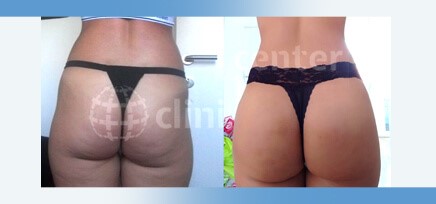 Buttock Lift / Butt Lift - Dr. Turkof - Vienna