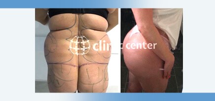 Brazilian Butt Lift Surgery Packages In Turkey