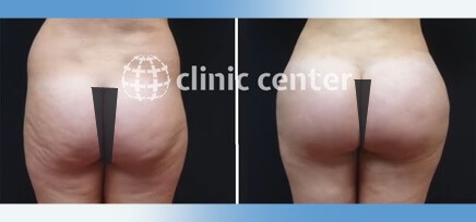 Mira-clinic  Brazilian Butt Lift (BBL) Price in Turkey & US & UK & Canada