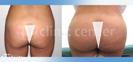 Brazilian Butt Lift Gallery - Aydin Center for Plastic Surgery