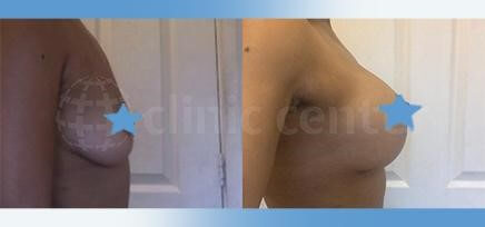 breast augmentation turkey before after