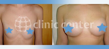 breast augmentation turkey before after