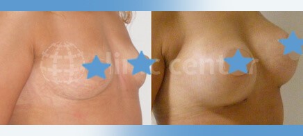 breast augmentation turkey before after