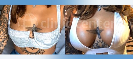 breast augmentation turkey before after