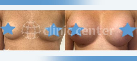 breast augmentation turkey before after