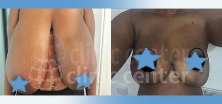 breast reduction turkey before after