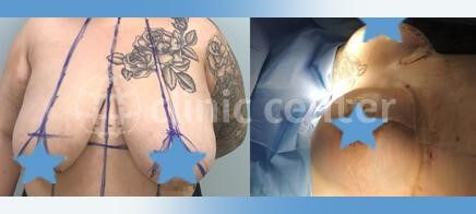 breast reduction turkey before after