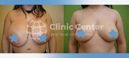 breast reduction turkey before after