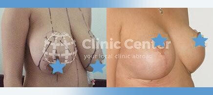 breast reduction turkey before after