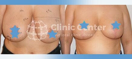 breast reduction turkey before after