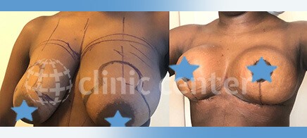 breast lift turkey before after