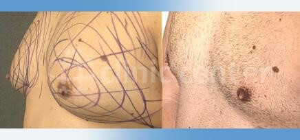 gynecomastia surgery turkey