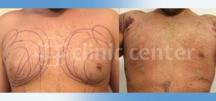 gynecomastia surgery turkey