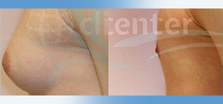 gynecomastia surgery turkey