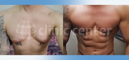 gynecomastia surgery turkey