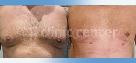 gynecomastia surgery turkey