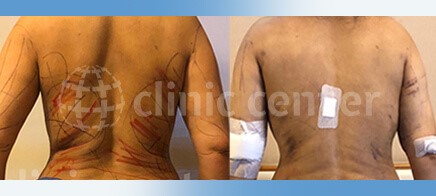 liposuction turkey before after