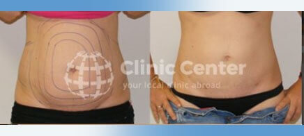 liposuction turkey before after