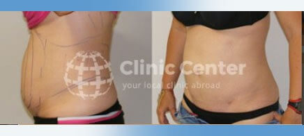 liposuction turkey before after