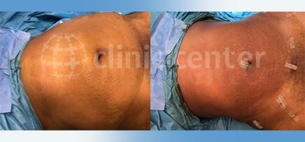 liposuction turkey before after