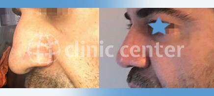 Nose Job Turkey Before After