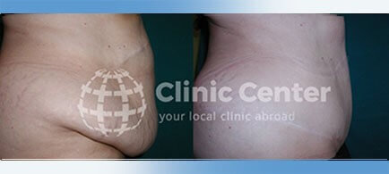 Tummy Tuck Turkey - Clinicpark