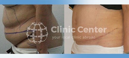 tummy tuck turkey before after