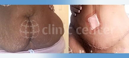 tummy tuck turkey before after