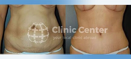 tummy tuck turkey before after