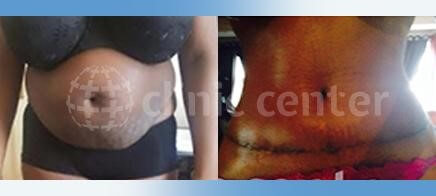 tummy tuck turkey before after