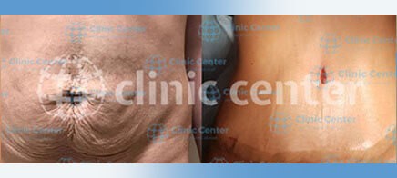 tummy tuck turkey before after