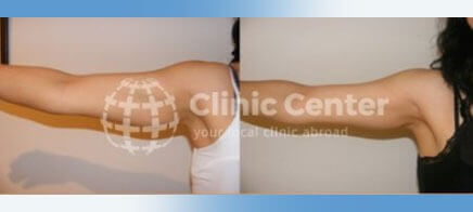 vaser liposuction turkey before after